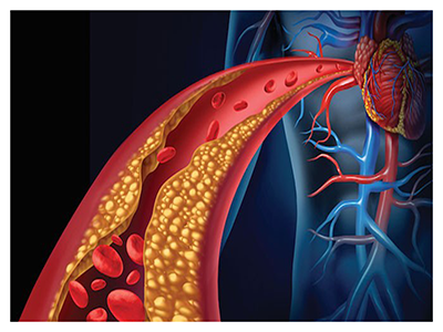 Acute coronary syndrome 